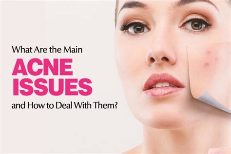 What Are The Main Acne Issues And How To Deal With Them Dr Sushma Raavi