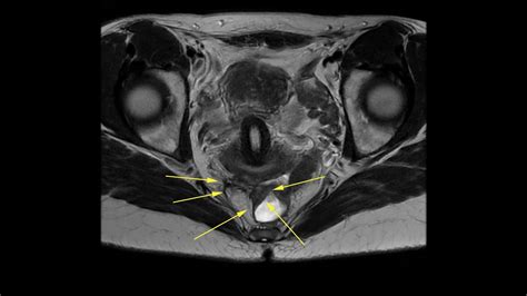 Large Rectal Disc Excision And Sacral Plexus Releasing For Deep Endometriosis Of Parametria