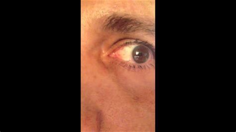 Eye Lens Flicker After Cataract Surgery 3 Dysphotopsia Youtube