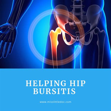 Helping Hip Bursitis ⋆