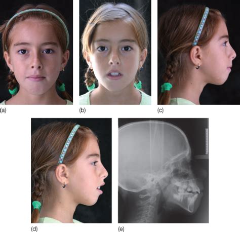 Adenoid Face Before And After