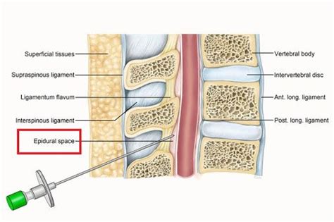 The Epidural Space Is An Area Behind The Spinal Cord And Spinal Fluid