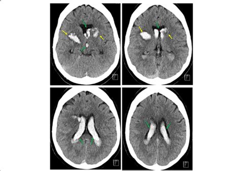 Bilateral Intraventricular Hemorrhage After Spinal Surgery In The Pacu