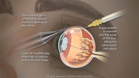 How much your vision improves depends on the damage the detachment caused to the cells of the retina. Retinal Detachment Shawnee Mission, KS - Retina Associates, PA
