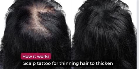 Scalp Tattoo For Thinning Hair To Thicken How It Works