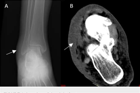Figure 1 From Severe Lower Extremity Cellulitis Caused By An Unusual
