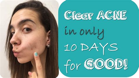 How I Cleared My Acne In 10 Days With Natural Ways Youtube
