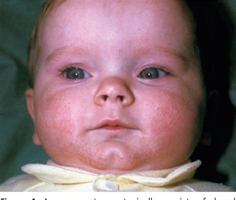 Figure 7 From Newborn Skin Part I Common Rashes Semantic Scholar