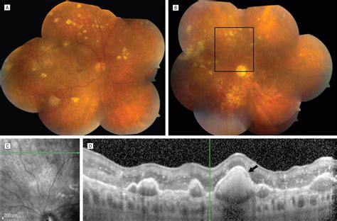 Primary Central Nervous System Lymphoma With Ocular Involvement