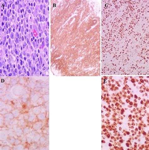 Diffuse Large B Cell Lymphoma Of The Colon In An Asymptomatic Patient
