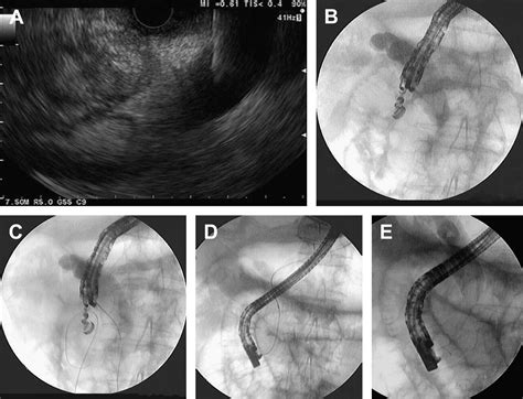 Endoscopic Ultrasonography Guided Biliary Drainage Rendezvous