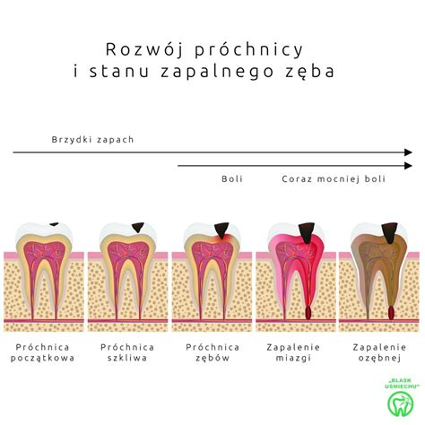 Rozwój próchnicy i stanu zapalnego zęba Stomatolog Bydgoszcz Blask