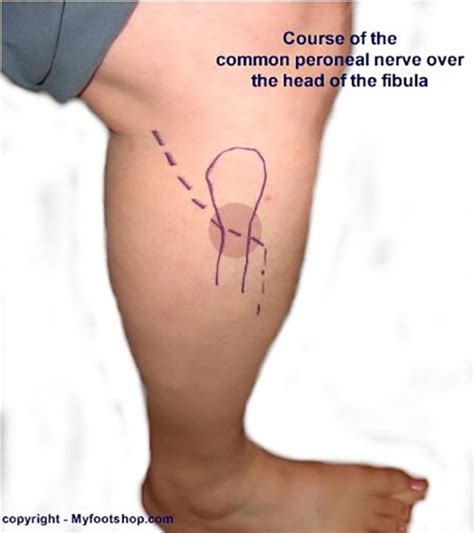 Peroneal Palsy Onset And Treatment Options
