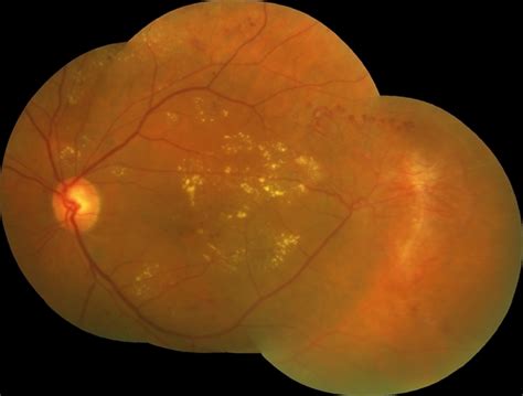 Proliferative Diabetic Retinopathy With Temporal Seafan Nve Dragging