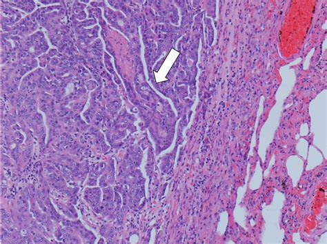 Canine Prostate Carcinoma Four Clinical Cases In Sexually Intact And