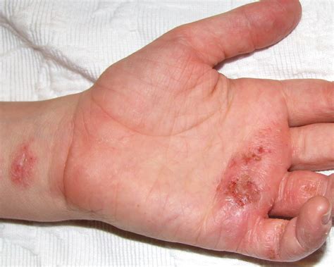 Eczema On Wrist Hand And Fingers 7 Year Old With Eczema Flickr