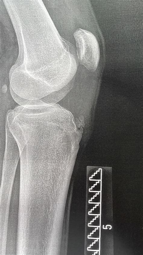 Got Diagnosed With Osgood Schlatter Disease Rradiology
