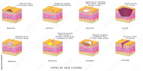 Fototapeta Types Of Skin Lesions Dermatology Primary And Secondary