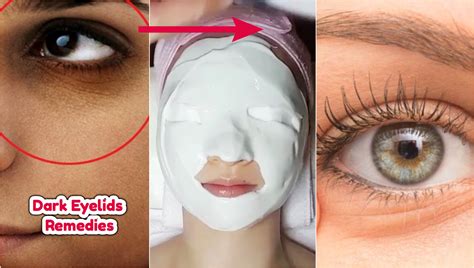 How To Get Rid Of Dark Spots On Eyelids Makeupview Co