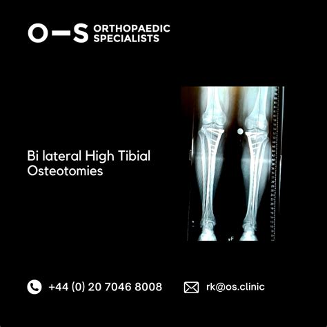 High Tibial Osteotomy For Knee Osteoarthritis Orthopaedic Specialists