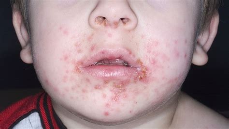 How Long Does Impetigo Live On Toys Toywalls