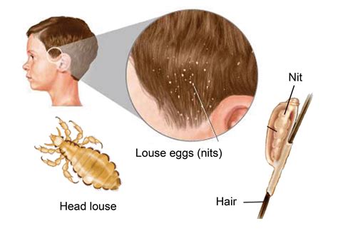 What Are Head Lice Health Life Media