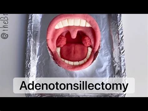 Playdough Surgery Tonsillectomy And Adenoidectomy YouTube
