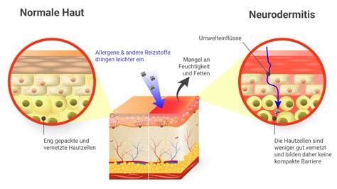 Atopisches Ekzem Neurodermitis Ursachen Im Überblick Haut Ratgeber
