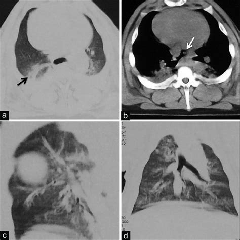 Hrct Scans Of The Ss Group A And B The Transverse Section Of The