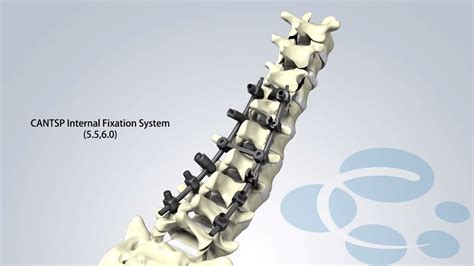 Canwell Spine Minimally Invasive Channel System Spine Surgery