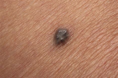 Nevus Stock Image C0063579 Science Photo Library