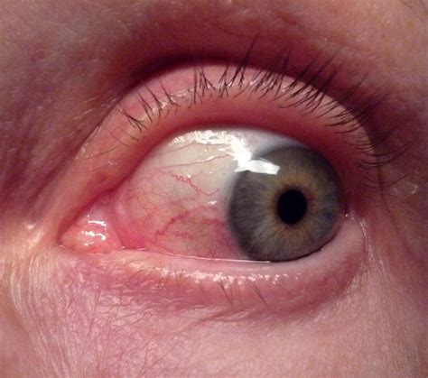 red spots in eyes causes and treatment smile delivery online