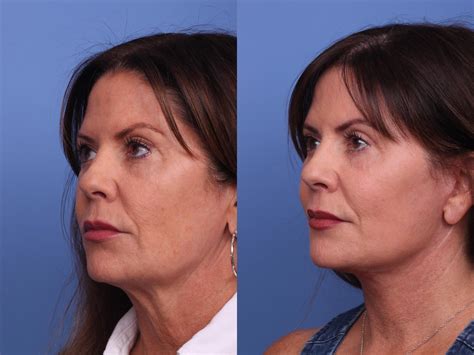 Facelift Before And After Pictures Case 467 Scottsdale Az Hobgood Facial Plastic Surgery