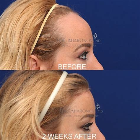 Forehead Reduction Surgery Hair Surgery Thinning Hairline Forehead