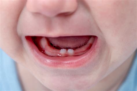 Eruption Of Your Childs Teeth Desert Dental Spa