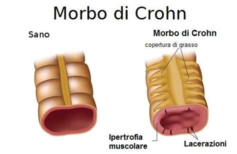 Morbo di Crohn quali sono i sintomi e le terapie Vivere più sani