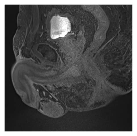 Synchronous Penile Metastasis From A High Grade Adenocarcinoma Of The