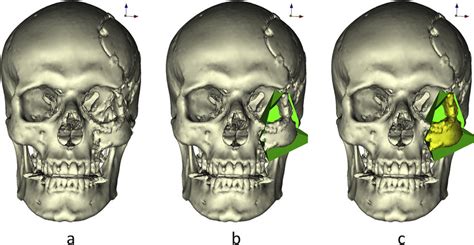 Planning Of The Osteotomy Plane And Segmentation Of The Osteosynthesis