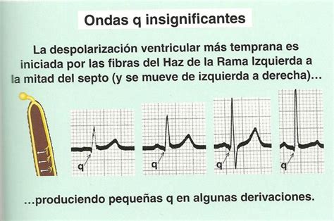 Electrocardiograma Y Medicina General Infarto Agudo De Miocardio Generalidades