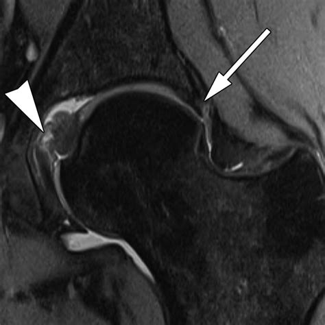 Mri Of Labral And Chondral Lesions Of The Hip Ajr