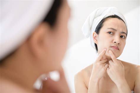 all about pimple popping is it really bad for your skin