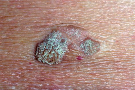 Seborrheic Keratosis Stock Image C0302171 Science Photo Library