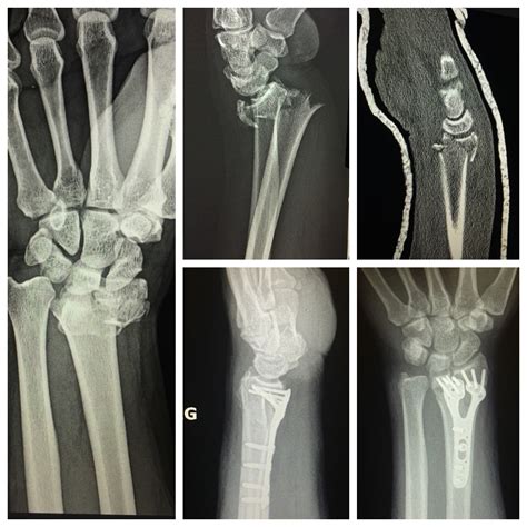 Causes And Risk Factors For Distal Radius Fracture