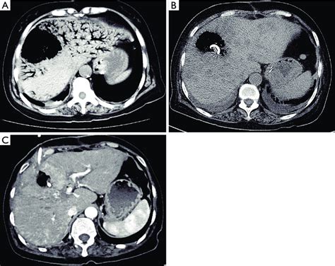 Ct Shows Extensive Gas Within The Intrahepatic Portal Venous System On