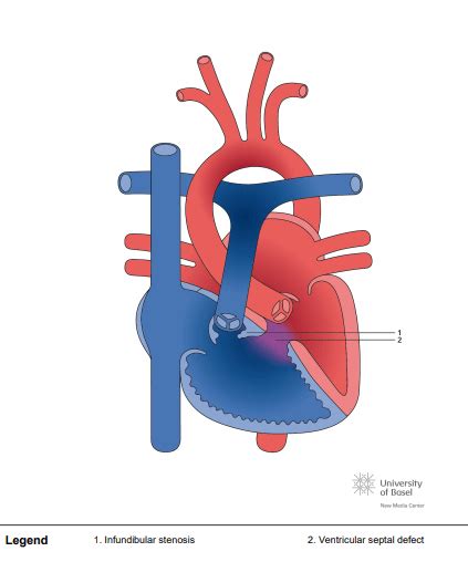 Right Ventricular Outflow Tract Obstruction With Vsd Perfusfind