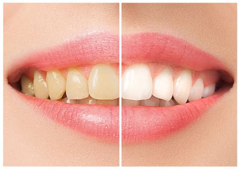 Teeth Whitening Stock Photos Pictures And Royalty Free Images Istock