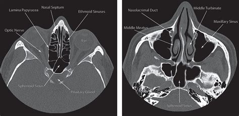 Ct Anatomy Of Sinuses Enteducationswansea