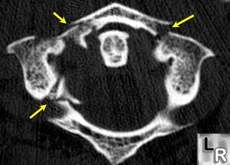 Atlas Fractures Transverse Ligament Injuries Spine Orthobullets