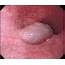 Endoscopic Image Showing A Bluish Soft Round Protruding Submucosal Mass 