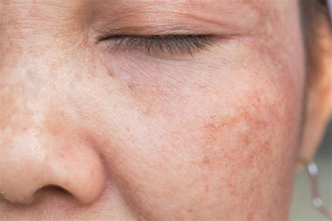 What Are Age Spots And What Causes Them By Boldcosmetics Medium